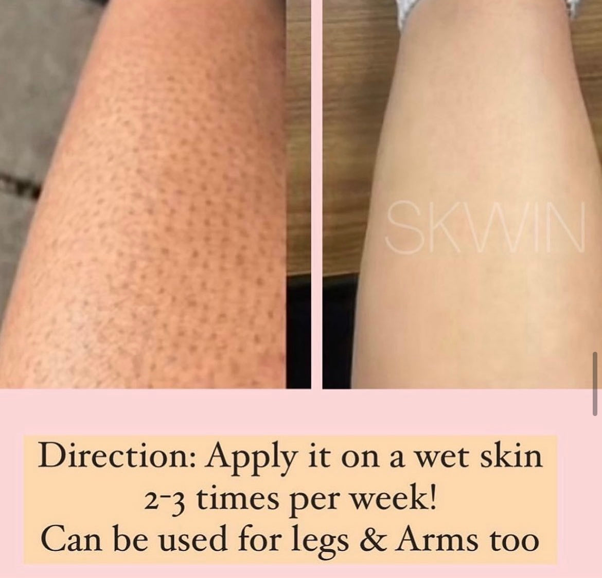 Keratosis pilaris